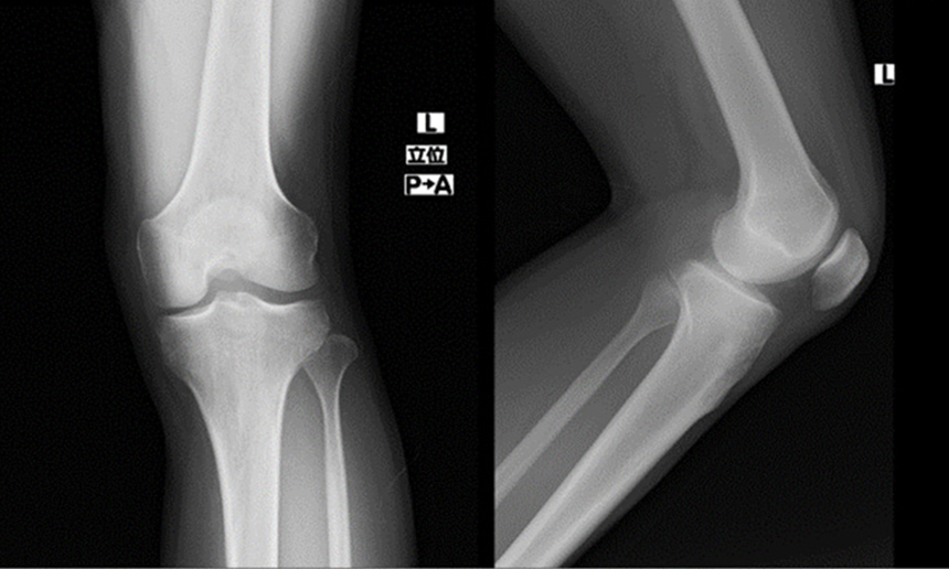 画像：左膝の痛みの患者様　レントゲン