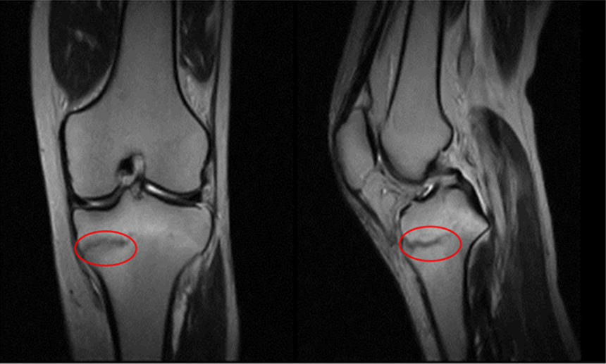 画像：左膝の痛みの患者様　MRI