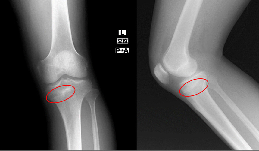 画像：左膝の痛みの患者様　1カ月後のレントゲン