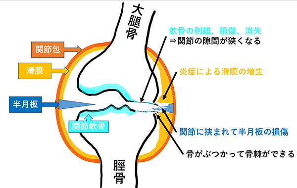 画像:変形性膝関節症の発症1