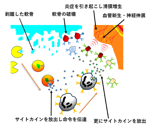 画像:変形性膝関節症の発症2